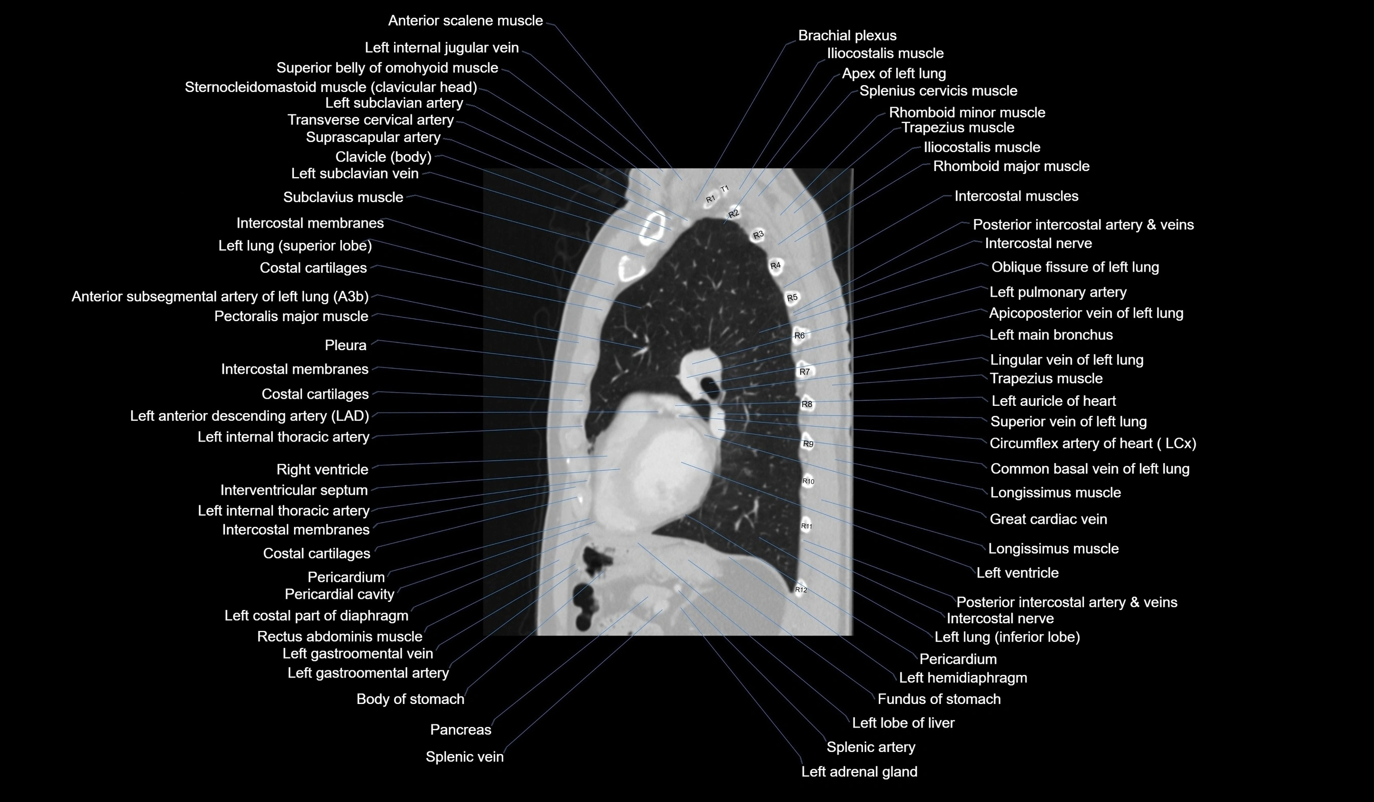 CT chest (thorax) lung window labelled sagittal cross sectional anatomy radiology image-00090.webp